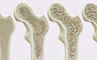 You can’t improve bone density… or can you?